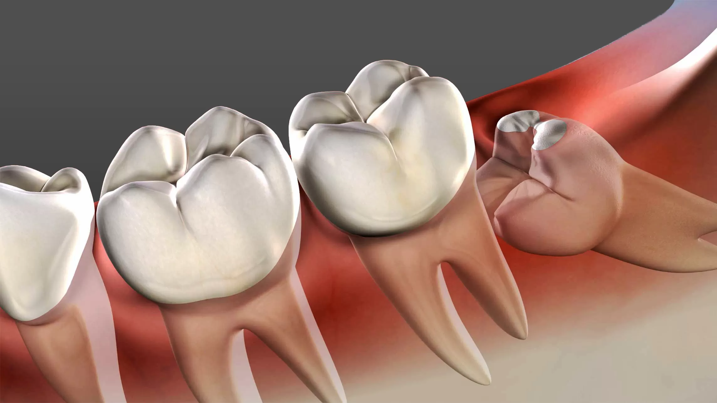 Are all wisdom teeth supposed to be extracted?