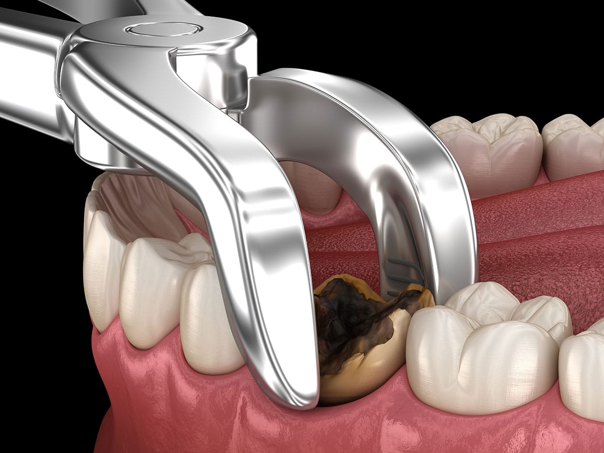 Are All Wisdom Teeth Supposed To Be Extracted, Wisdom Teeth Extraction Query, Extracting All Wisdom Teeth, Wisdom Tooth Removal Decision, Extracting Wisdom Molars, Dental Dilemma Wisdom Teeth Removal, Wisdom Teeth Evaluation, Should Every Wisdom Tooth Be Extracted, Extract or Retain Wisdom Teeth, Extracting Wisdom Teeth Pros and Cons, Wisdom Tooth Extraction Controversy, Extracting All Third Molars, Wisdom Teeth Removal Inquiry, Deciding on Wisdom Tooth Extraction, Extracting Wisdom Teeth Consideration, The Wisdom Teeth Extraction Debate, Extracting Wisdom Teeth Yes or No, Wisdom Teeth Extraction Assessment, To Extract or Not To Extract Wisdom Teeth, Wisdom Teeth Extraction Exploration, The Conundrum of Wisdom Teeth Removal, Extracting Wisdom Teeth What